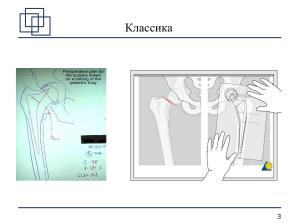 Использование СПО в планировании ортопедических оперативных вмешательств (Анатолий Якушин, OSSDEVCONF-2025).pdf