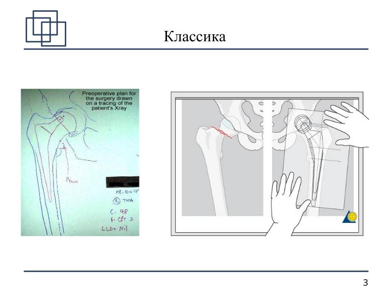 Файл:Использование СПО в планировании ортопедических оперативных вмешательств (Анатолий Якушин, OSSDEVCONF-2025).pdf