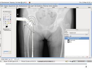 Использование СПО в планировании ортопедических оперативных вмешательств (Анатолий Якушин, OSSDEVCONF-2025).pdf