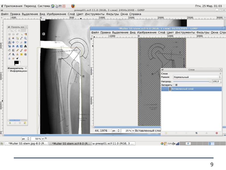 Файл:Использование СПО в планировании ортопедических оперативных вмешательств (Анатолий Якушин, OSSDEVCONF-2025).pdf