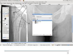 Использование СПО в планировании ортопедических оперативных вмешательств (Анатолий Якушин, OSSDEVCONF-2025).pdf
