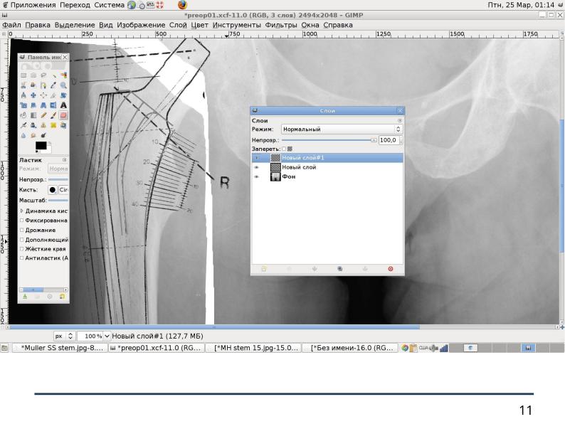 Файл:Использование СПО в планировании ортопедических оперативных вмешательств (Анатолий Якушин, OSSDEVCONF-2025).pdf