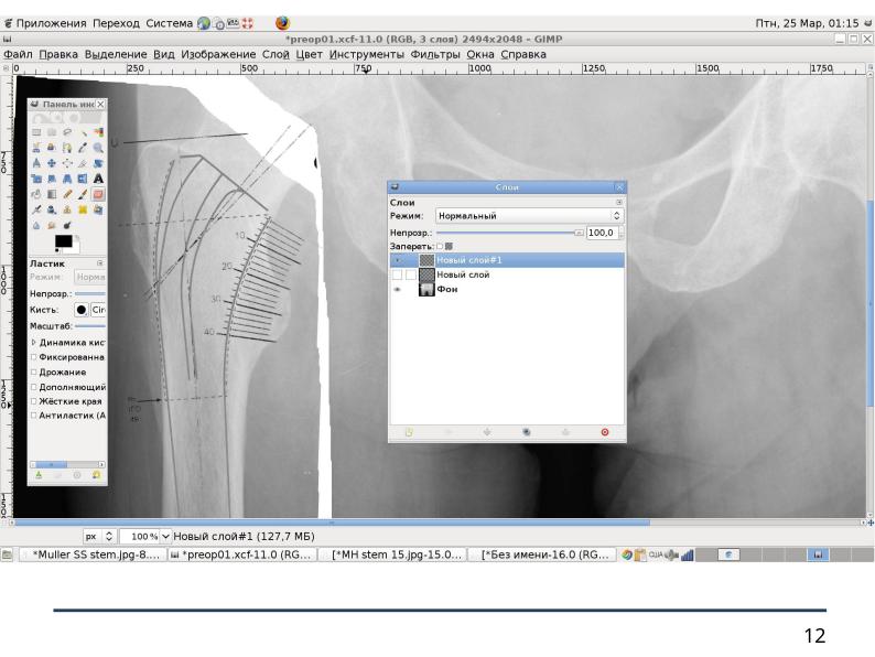 Файл:Использование СПО в планировании ортопедических оперативных вмешательств (Анатолий Якушин, OSSDEVCONF-2025).pdf